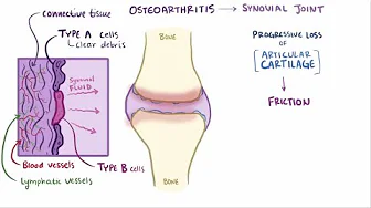 Osteoarthritis natural remedies