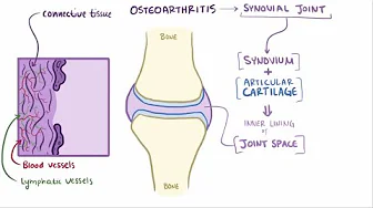 Osteoarthritis management strategies