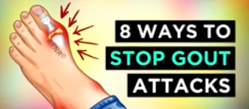 eight ways to stop gout attacks